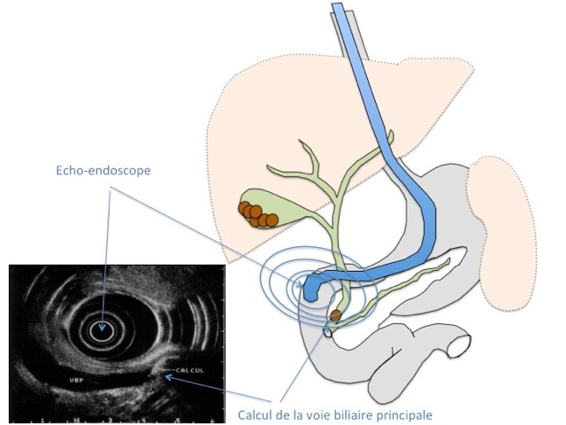 Les Examens Et Traitements Endoscopiques CBIPPS